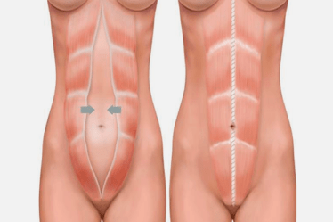 Abdominoplastia