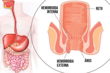 Qual a melhor forma de tratar as hemorroidas? ( Imagem: MD Saúde)