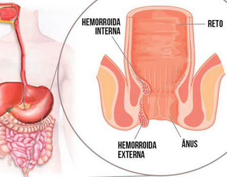 Qual a melhor forma de tratar as hemorroidas? ( Imagem: MD Saúde)