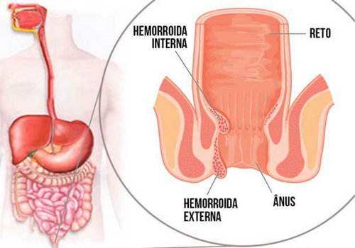 Qual a melhor forma de tratar as hemorroidas? ( Imagem: MD Saúde)